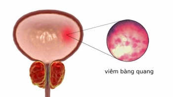 Tiểu buốt ra mủ ở nam giới là bị làm sao?