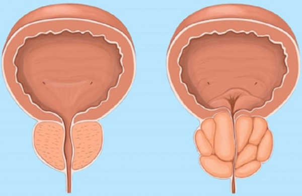 Tiểu ra máu ở nam giới: Cảnh báo bệnh lý nguy hiểm